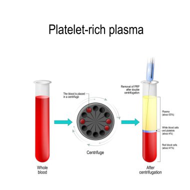 Platelet-rich plasma. Autologous conditioned plasma, is a concentrate of platelet-rich plasma derived from whole blood, centrifuged to remove red blood cells. blood test tube, centrifuge, syringe, and test tube with layers of blood components clipart