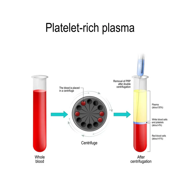 Plasma Rico Plaquetas Plasma Autólogo Condicionado Concentrado Plasma Rico Plaquetas — Vector de stock