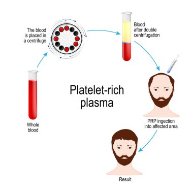 Trombosit açısından zengin plazma. PRP saç tedavisi. Tıbbi prosedür. Hangi ahair tarafından restorasyon cerrah alır bir hasta işlem kan, erytrocytes ve plazma kaldırır, sonra Prp sadece nerede saç büyüme isteniyorsa kafa derisi altında enjekte eder..