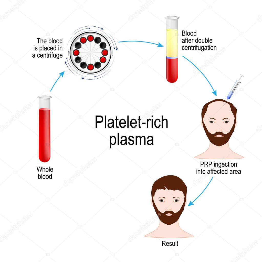 Platelet-rich plasma. PRP Hair Therapy. Medical procedure. Process by which ahair restoration surgeon takes a patients blood, removes the erytrocytes and plasma, then injects PRP just under the scalp where hair growth is desired.