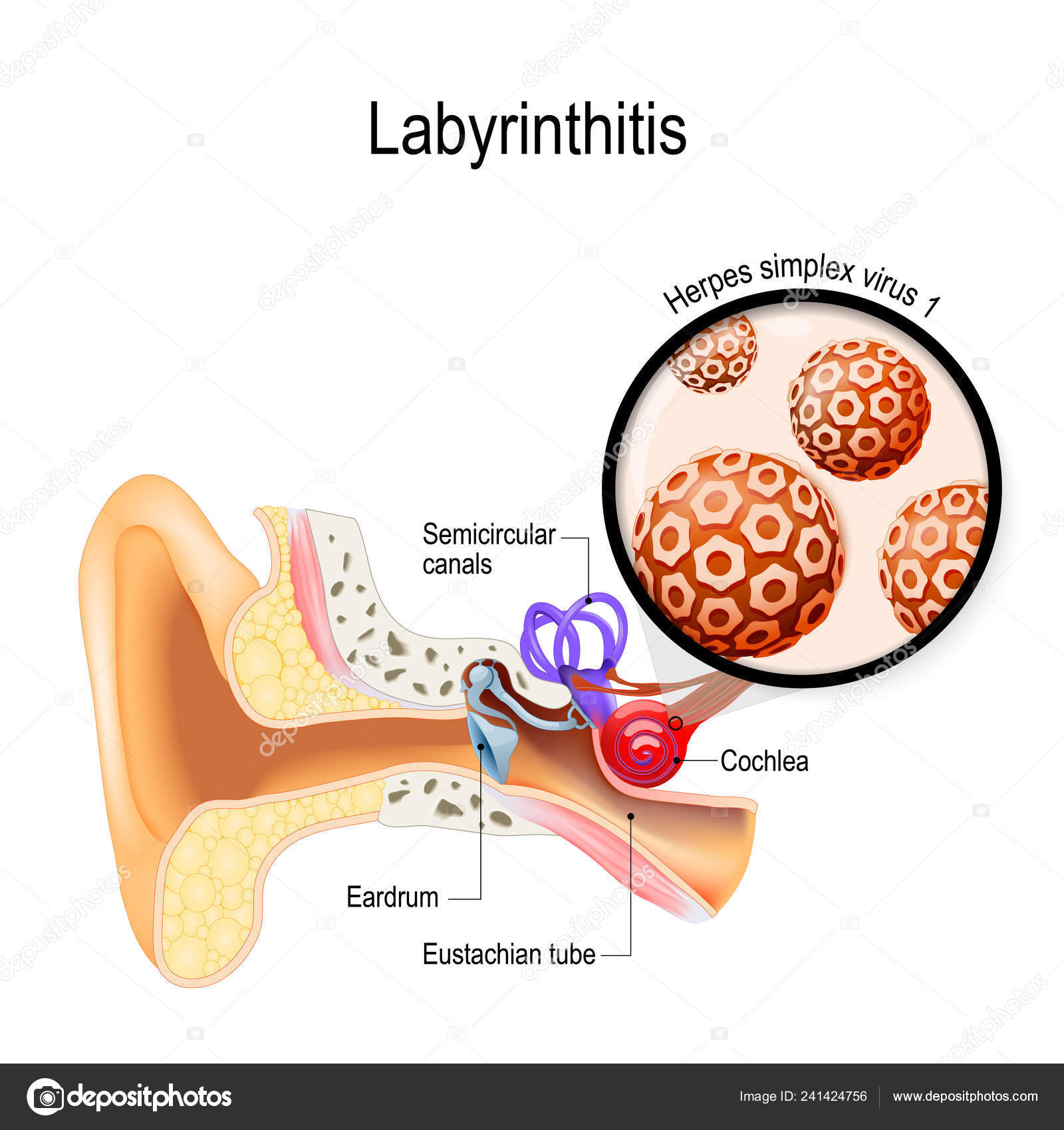 Laberintitis Neuritis Vestibular Inflamación Del Oído Interno Del Virus