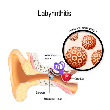 Labirent. Vestibüler nörite. Bu hastalığa yol açan virüs ve iç kulak iltihabı. Herpes simpleks virüsü. İnsan anatomisi. Vektör çizim tıbbî kullanım için