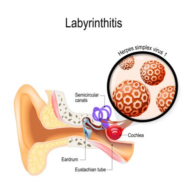Labyrinthitis. vestibular neuritis. inflammation of the inner ear and virus that caused this disease. Herpes simplex virus. Human anatomy. Vector illustration for medical use clipart