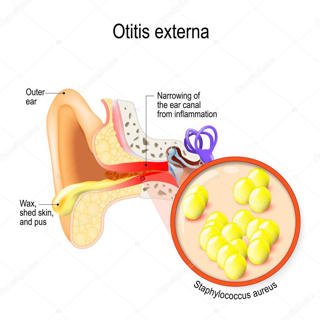 Swimmer's ear. Otitis externa is inflammation of the ear canal. bacteria that cause this disease. Close up of Staphylococcus aureus. Human anatomy. Vector illustration for medical use