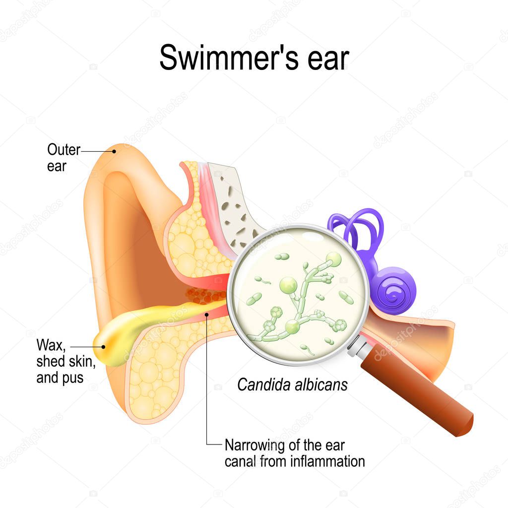 Otitis. swimmer's ear is inflammation of the ear canal and fungal infection that caused this disease. illustration showing Candida albicans close up, narrowing of the ear channel, the large amounts of exudate, and swelling of the outer ear. 