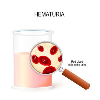 Hematuria. magnifying glass and beaker with urine. Closeup of Re clipart