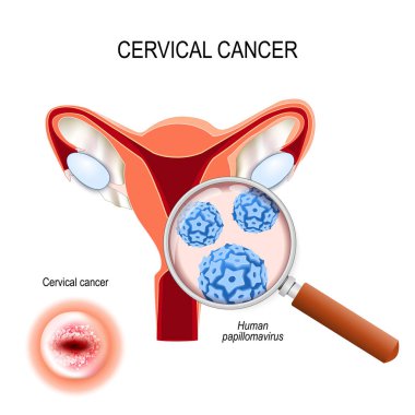 Servikal kanser. Human papilloma virüsü enfeksiyonunun yakın çekim (HPV
