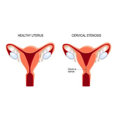 Uterus serviks stenozu. İnsan fertilitesi
