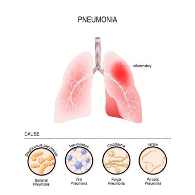 Pneumonia is caused by infection with viruses, bacteria, fungi a clipart