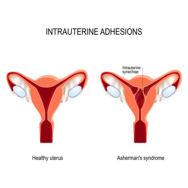 uterus yapışmaları. yara dokusu. Asherman sendromu