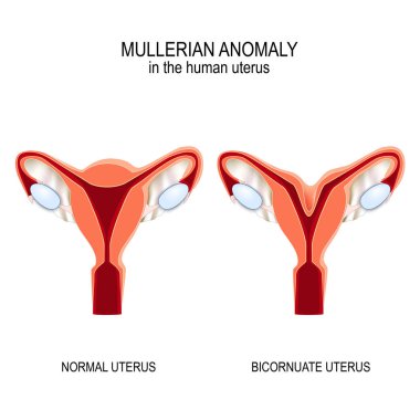 Normal womb and Bicornuate uterus. clipart