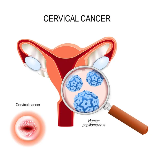Cancro do colo do útero. Close-up da infecção pelo papilomavírus humano (HPV — Vetor de Stock