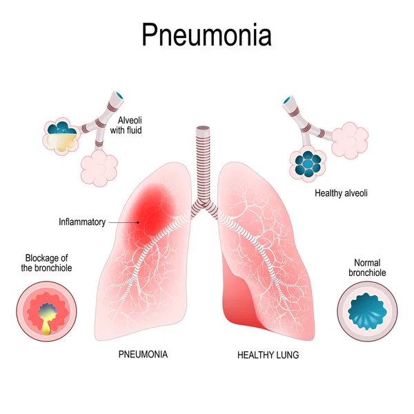 Pneumonia. Difference and Comparison of healthy lungs (bronchiol — Stock Vector