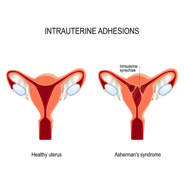 Adherencias uterinas. tejido cicatricial. Síndrome de Asherman — Archivo Imágenes Vectoriales