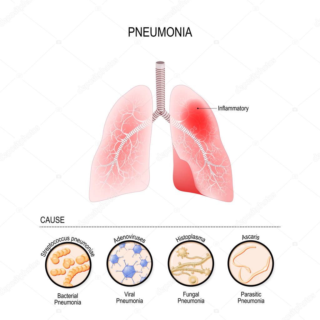 Pneumonia is caused by infection with viruses, bacteria, fungi a