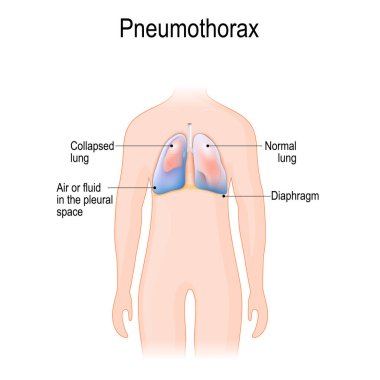 pneumothorax clipart