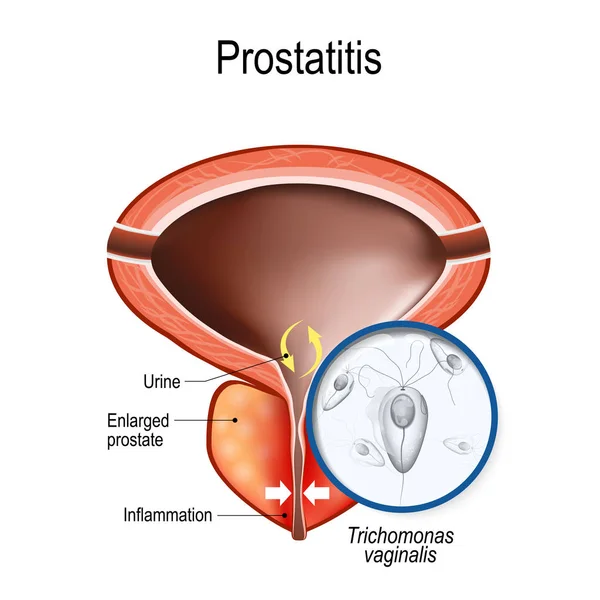 Prostatitis and close-up of Trichomonas vaginalis — Stock Vector