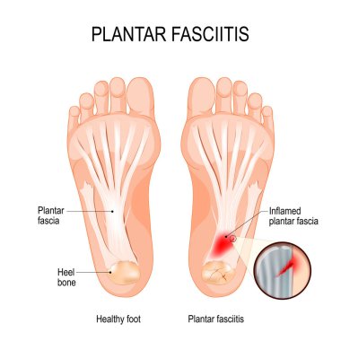 Plantar fasciitis. disorder of the connective tissue which suppo clipart
