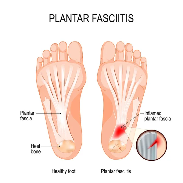 Fascitis plantar. trastorno del tejido conectivo que suponen — Vector de stock