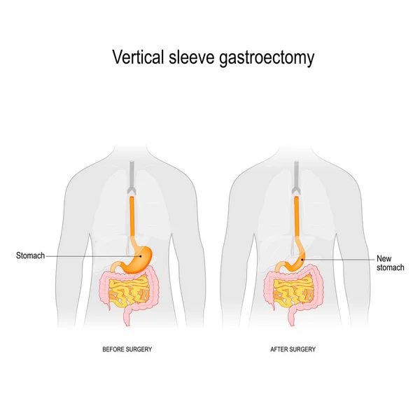 Gastroectomia a maniche verticali. prima e dopo l'intervento. peso l — Vettoriale Stock