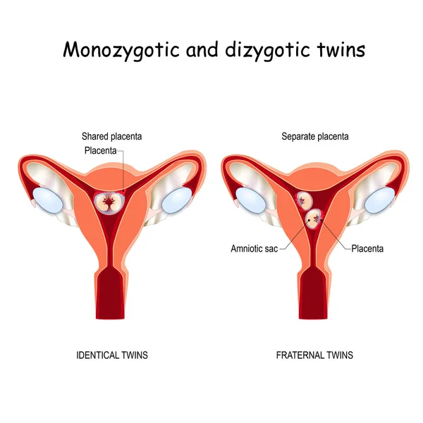 Ikrek a méhben. Monozygotic és dizygotic — Stock Vector