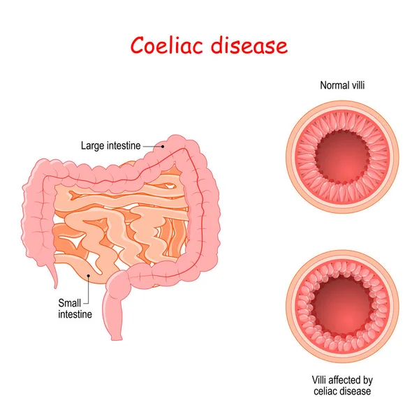 Enfermedad celíaca. Sección transversal del intestino delgado con vellosidades normales — Vector de stock