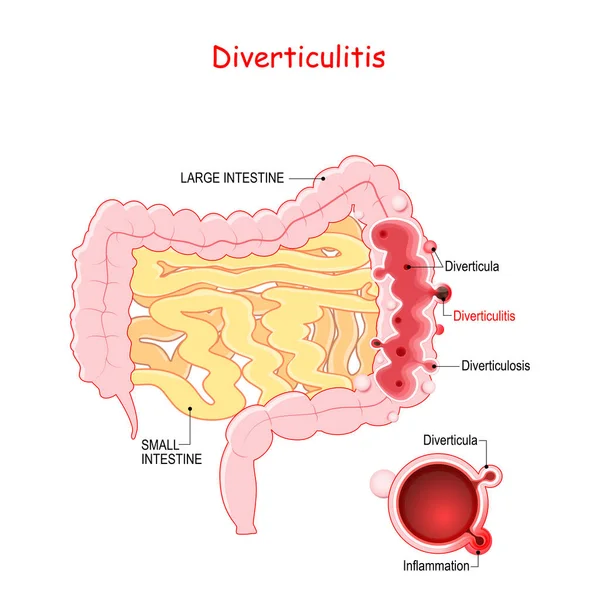 Diverticulosis and Diverticulitis — Stock Vector