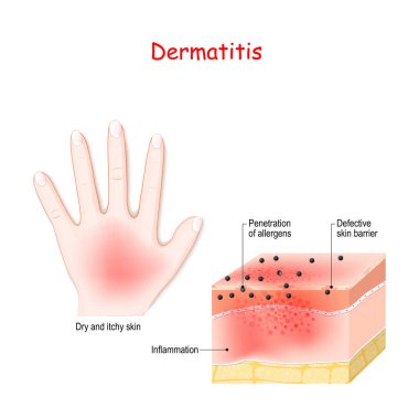 Dermatit. Atopik egzama. İnsan Kesitinin Yakın Çekim