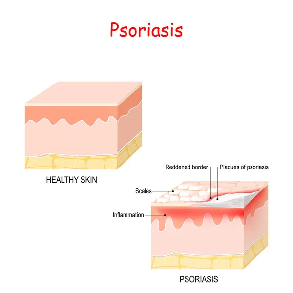 Normal skin and psoriasis. — Stock Vector