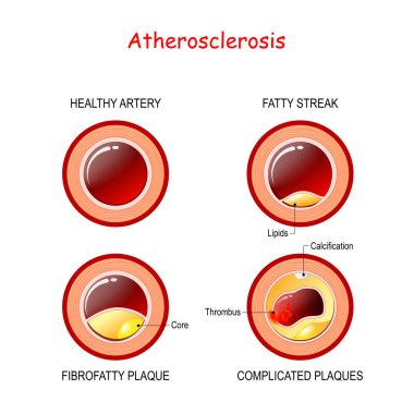 ateroskleroz aşamaları. Arterde kolesterol
