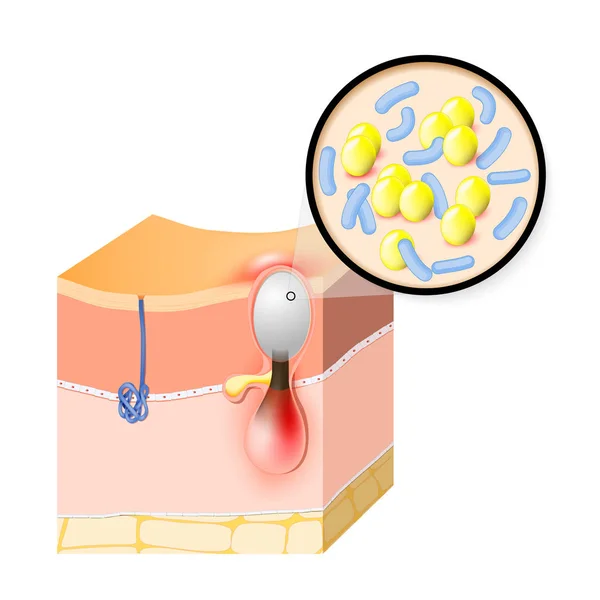 Acne vulgaris. közeli baktériumok, amelyek bőrbetegséget okoznak — Stock Vector