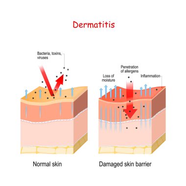 Dermatitis. Normal and skin with Damaged barrier. protection eff clipart
