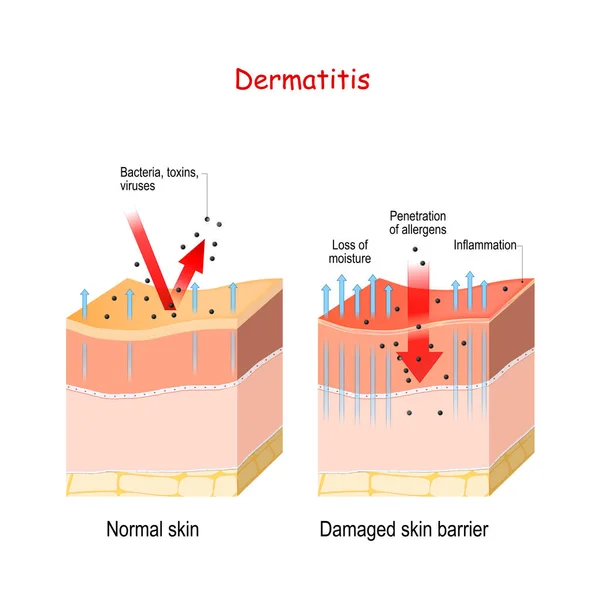 Дерматит. Нормальная и кожа с поврежденным барьером. защита окружающей среды — стоковый вектор