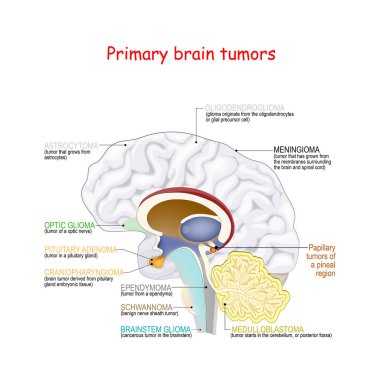 Brain cancer. different types of primary brain tumors clipart