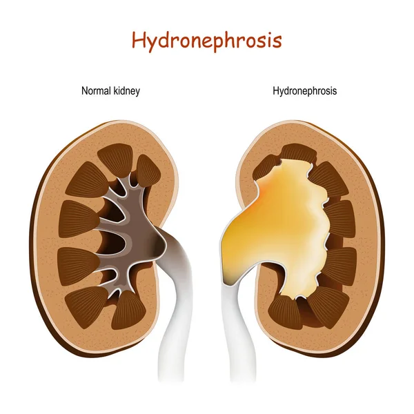 ヒドロネフシス 通常の腎臓と障害を持つ腎臓 尿路への閉塞による腎臓骨盤の伸展と石灰化 — ストックベクタ
