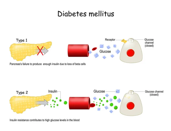 Types Diabetes Mellitus — Stock Vector