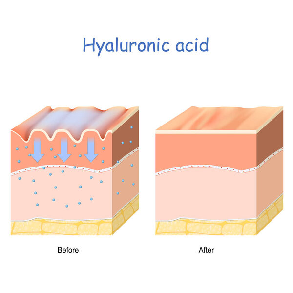 Hyaluronic acid. skin-care products. skin rejuvenation with help of hyaluronic acid. wrinkles on the human skin. Before and after use of the hyaluronic acid