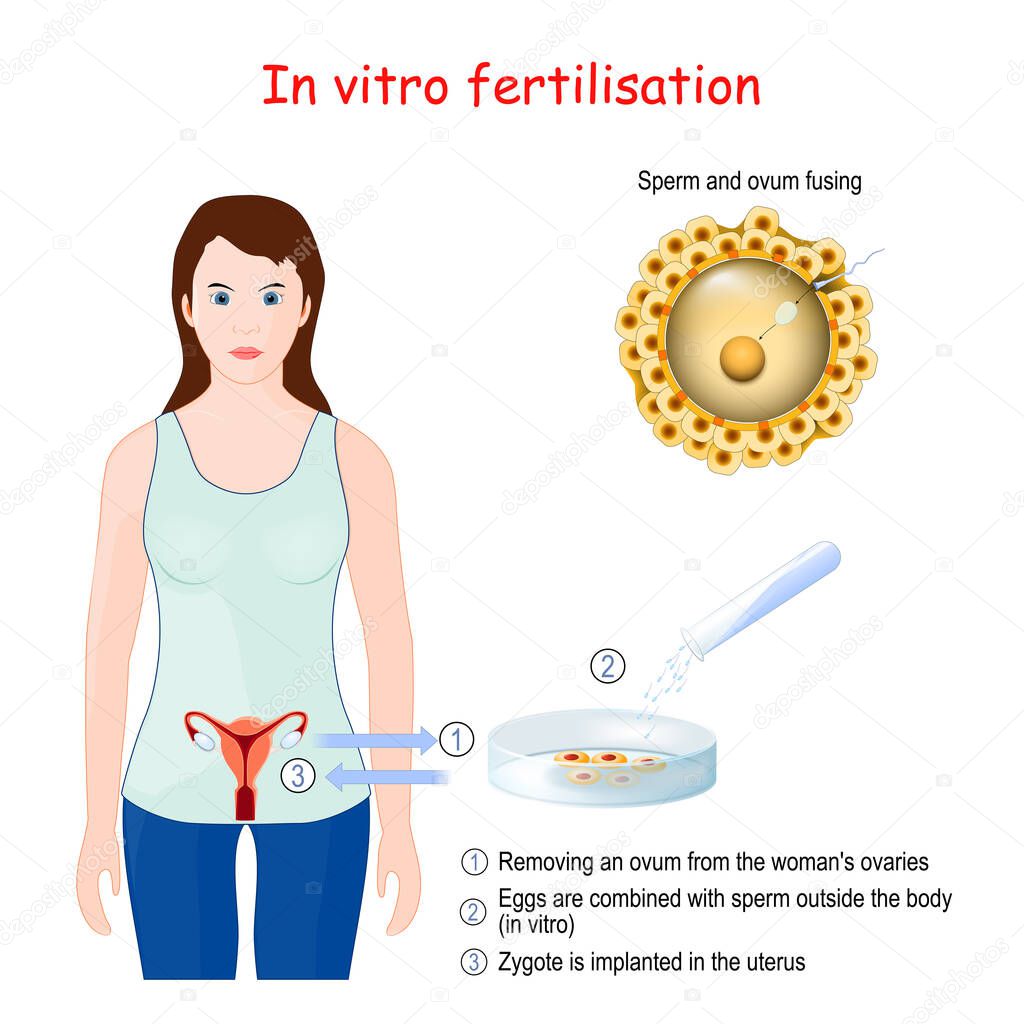 In vitro fertilization (IVF). Close up of Sperm and ovum fusing. Removing an ovum from the woman's ovaries. Eggs are combined with sperm outside the body. Zygote is implanted in the uterus.