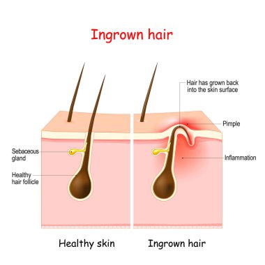 Ingrown hair after hair removal and shaving. buried hair. structure of the hair follicle. Vector illustration