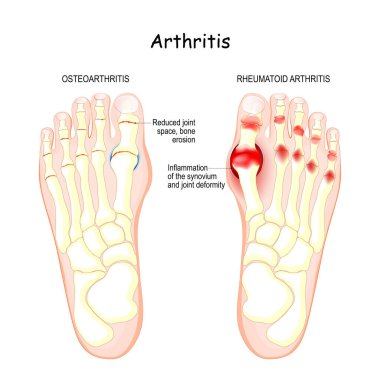 osteoarthritis, rheumatoid arthritis, and posttraumatic arthritis. comparison of human foot with different forms of arthritis. inflamed synovium and joint deformity clipart