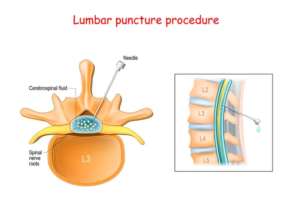 Lumbar Punctieprocedure Spinale Zenuwwortels Spinal Tap Procedure Close Van Wervelkolom — Stockvector