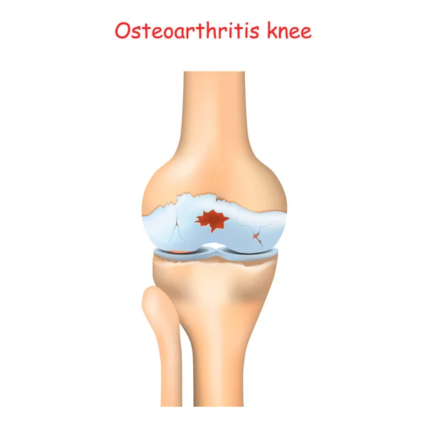 Knie Arthrose Arthritis Oder Gelenkschmerzen Degenerative Gelenkerkrankungen Realistische Vektordarstellung — Stockvektor