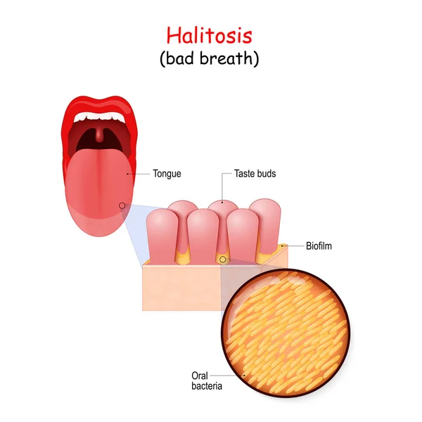 Mundgeruch Und Bakterien Die Mundgeruch Verursachen Menschlicher Mund Und Nahaufnahme — Stockvektor