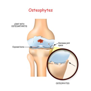 Osteofit. Kemik iltihabı olan insan diz eklemi. Mahmuzları kapat ve eklem alanını daralt.