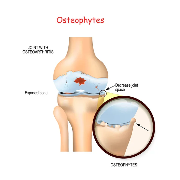 オステオフィテだ 変形性関節症とのヒト膝関節 スプルースの閉まりとジョイントスペースの狭まり — ストックベクタ