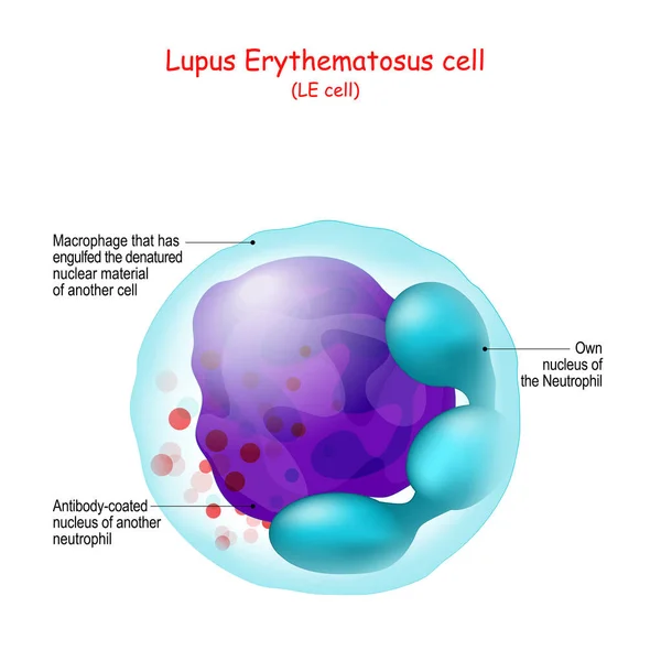 Lupus Erythematosus Cellen Uppbyggnad Cellen Mänsklig Anatomi Närbild Neutrofila Eller — Stock vektor