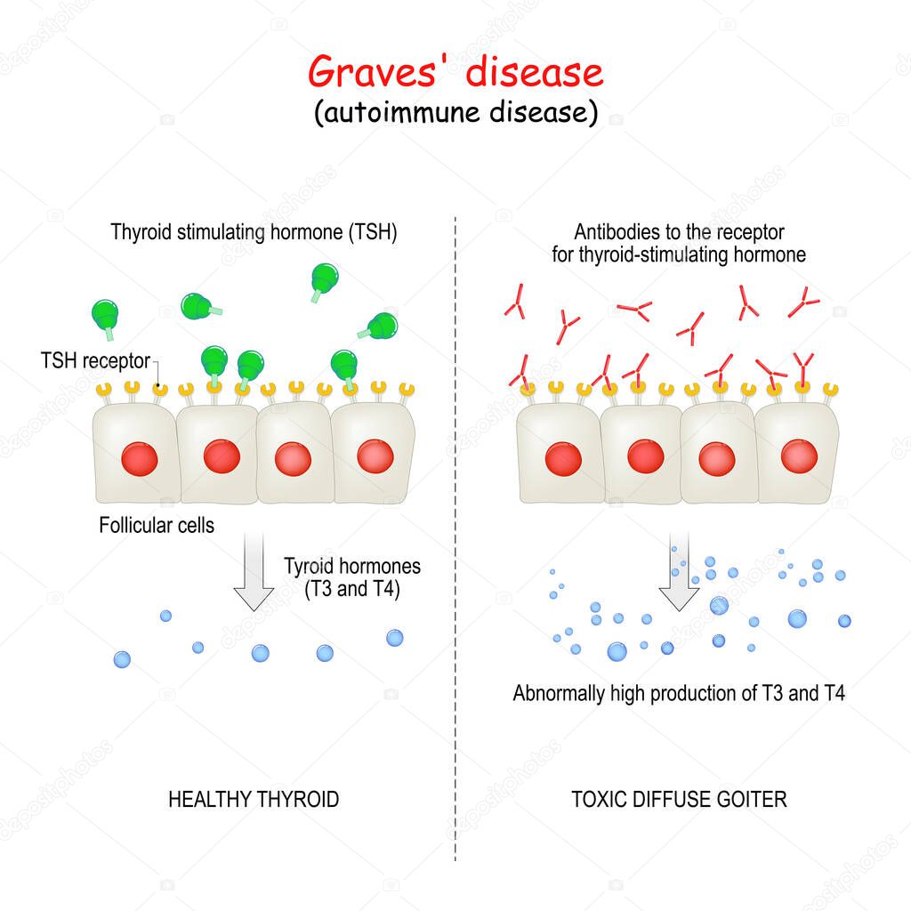 Graves' disease. autoimmune disorder. toxic diffuse goiter and cell of healthy thyroid gland. explanation about Abnormally high production hormones of thyroid gland (T3 and T4).