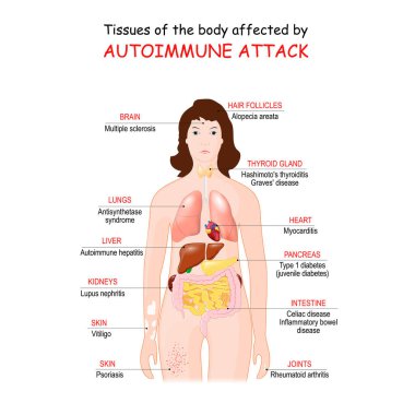 tissues of the body affected by autoimmune attack. Vector illustration for medical use clipart