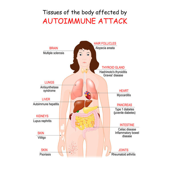 tissues of the body affected by autoimmune attack. Vector illustration for medical use