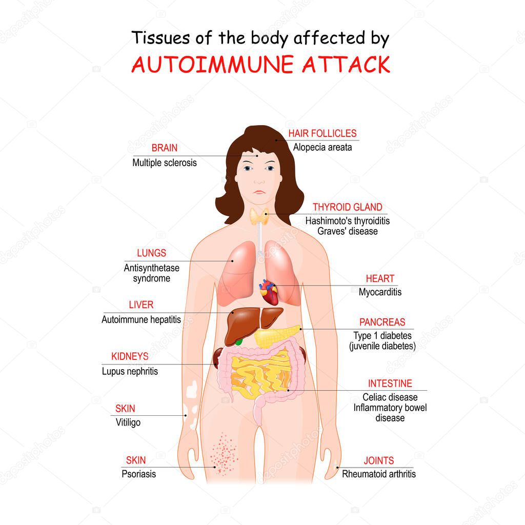 tissues of the body affected by autoimmune attack. Vector illustration for medical use